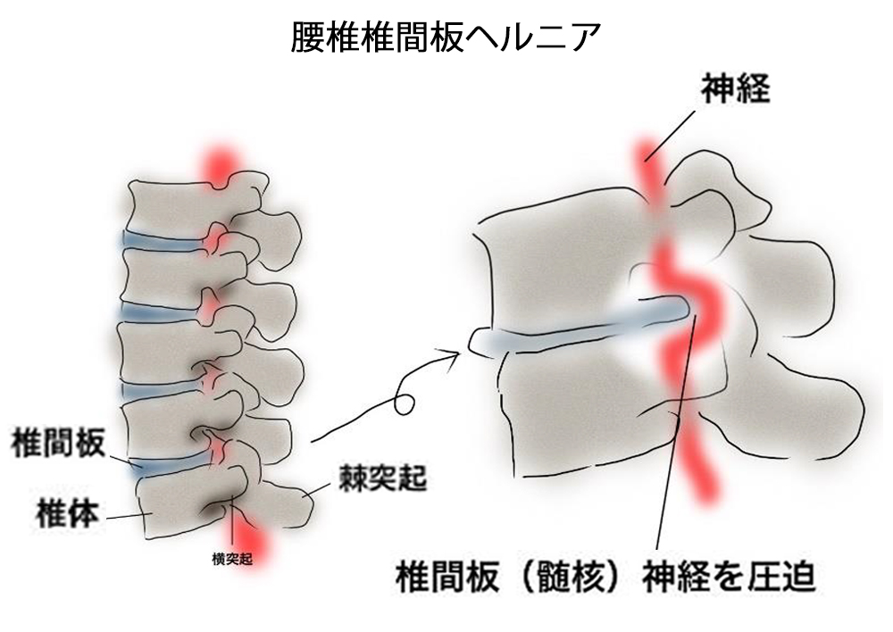 腰椎椎間板ヘルニア画像4